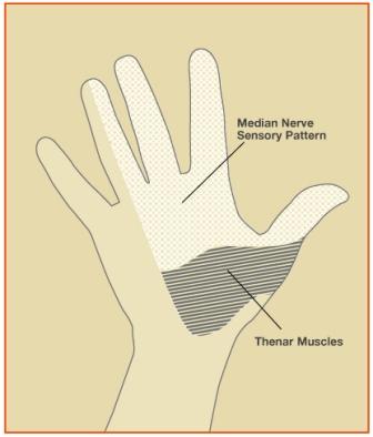 Carpal Tunnel Syndrome