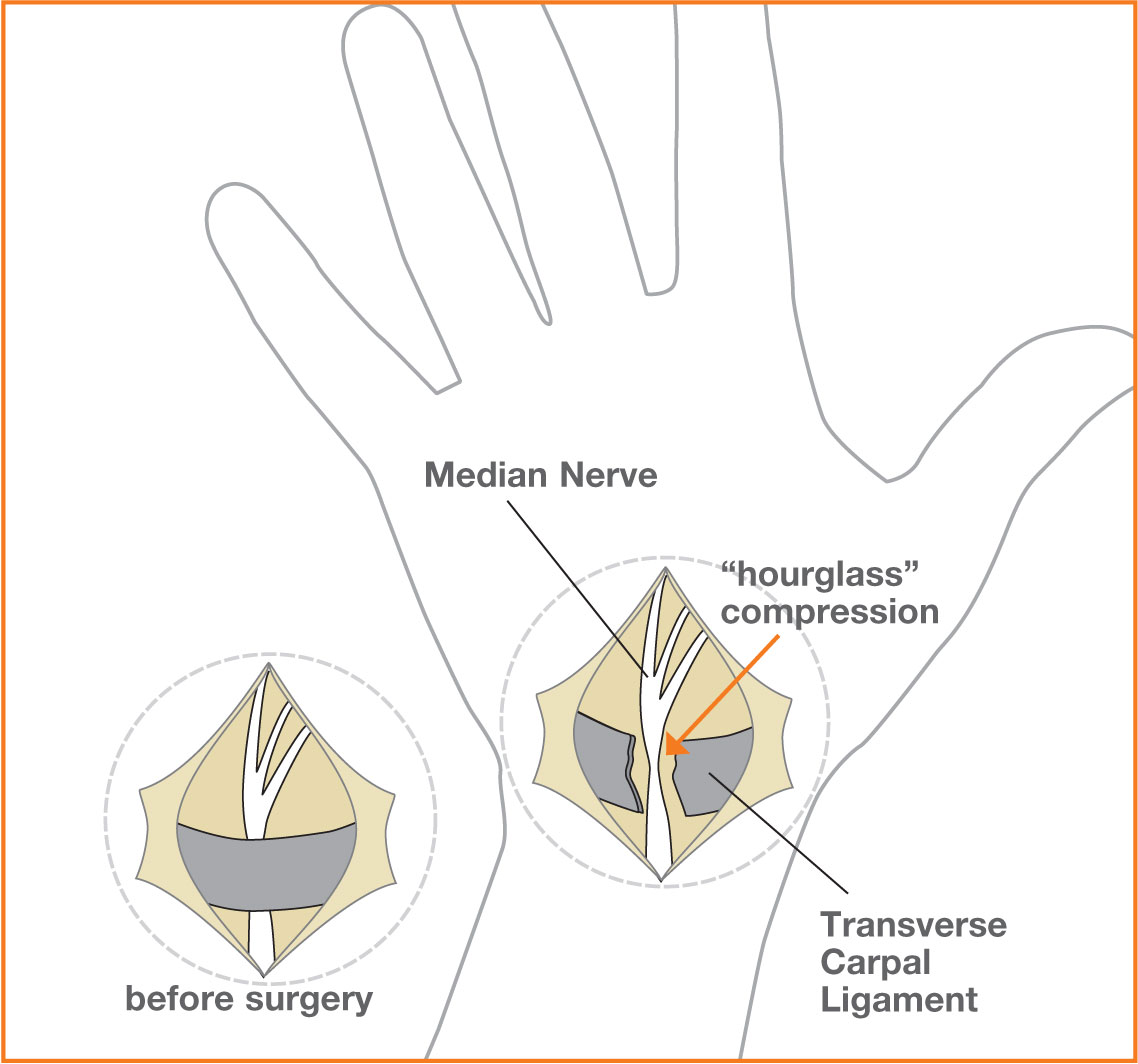 Carpal Tunnel Syndrome
