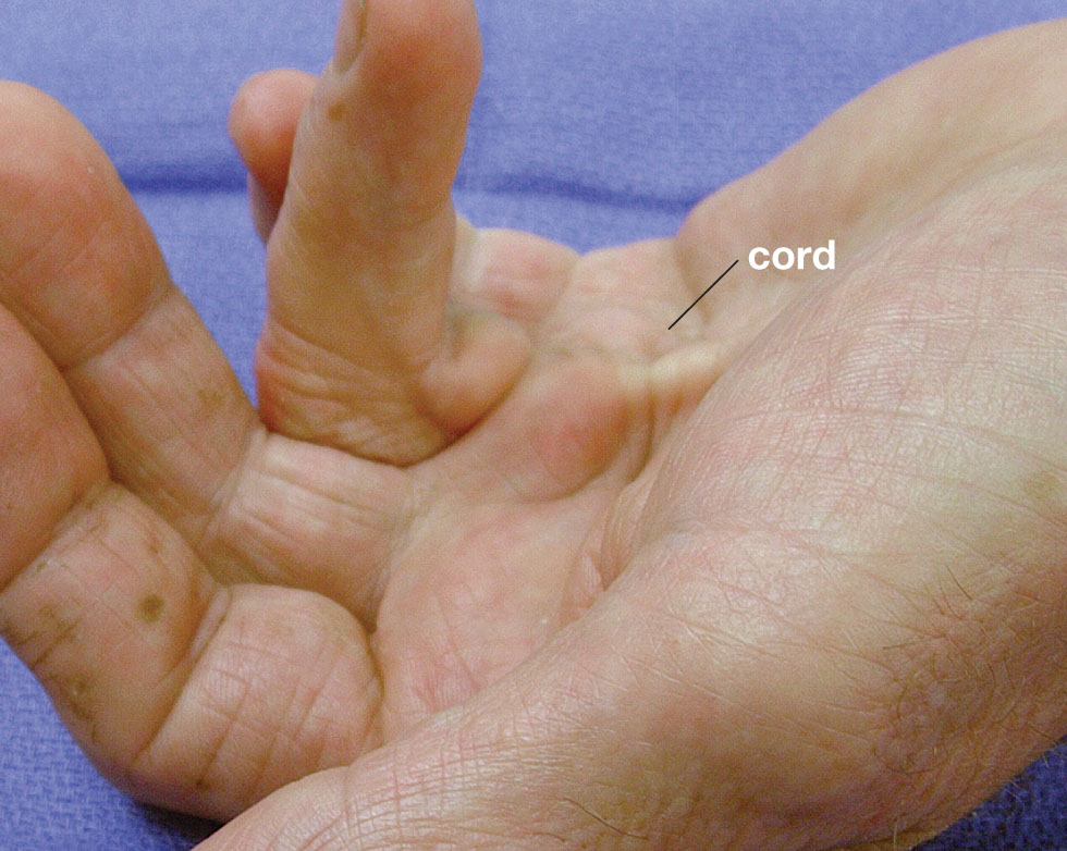 Dupuytren’s Disease