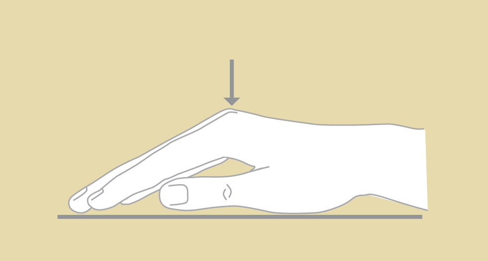 Dupuytren’s Disease