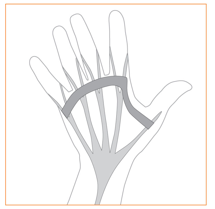 Dupuytren’s Disease