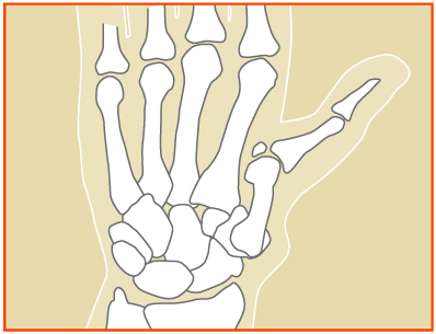 Basal Joint Arthritis