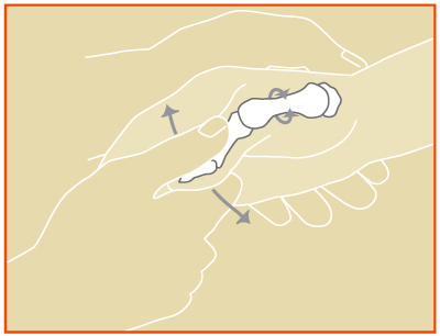 Basal Joint Arthritis
