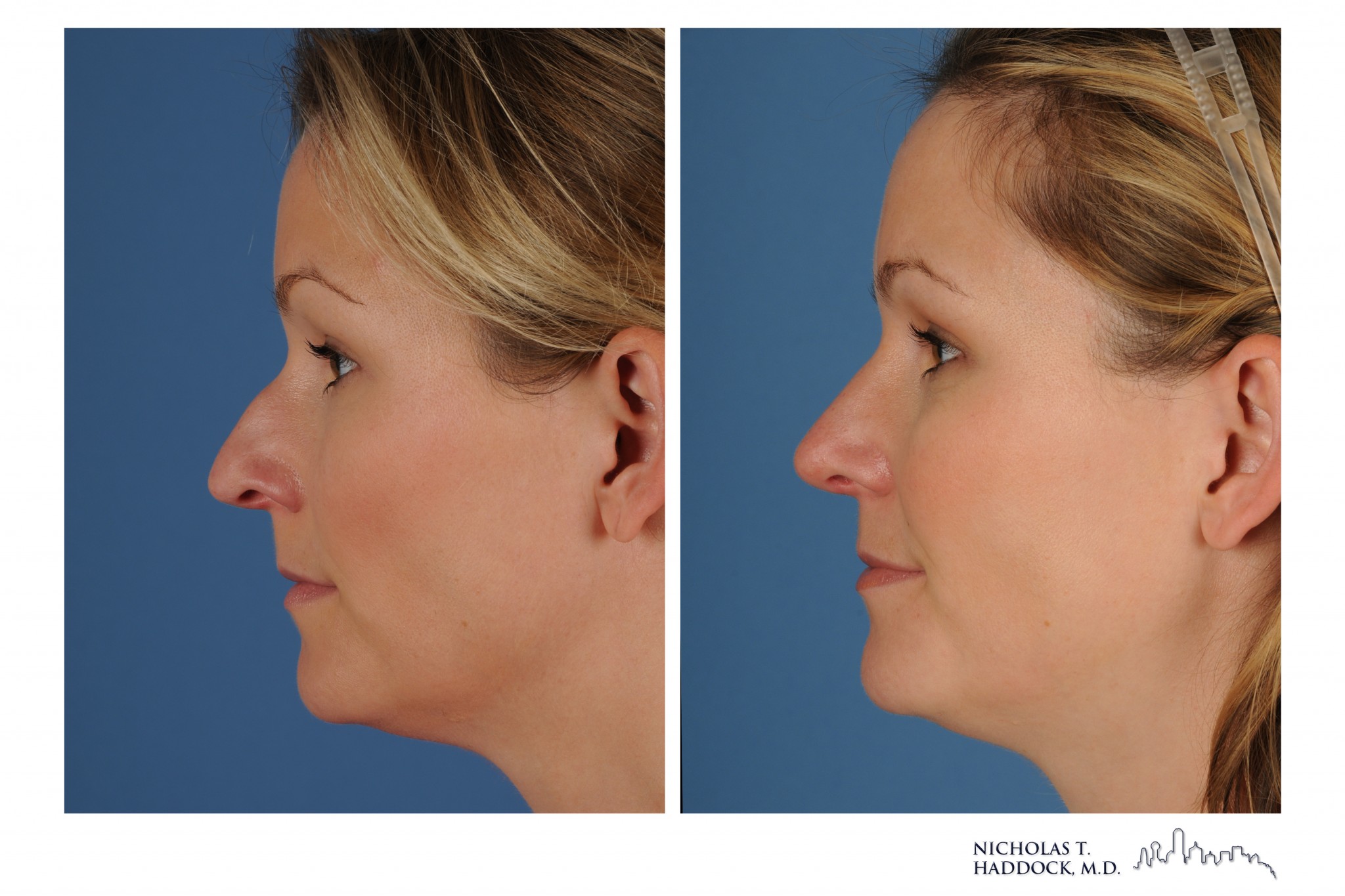 Rhinoplasty 1 LLAT