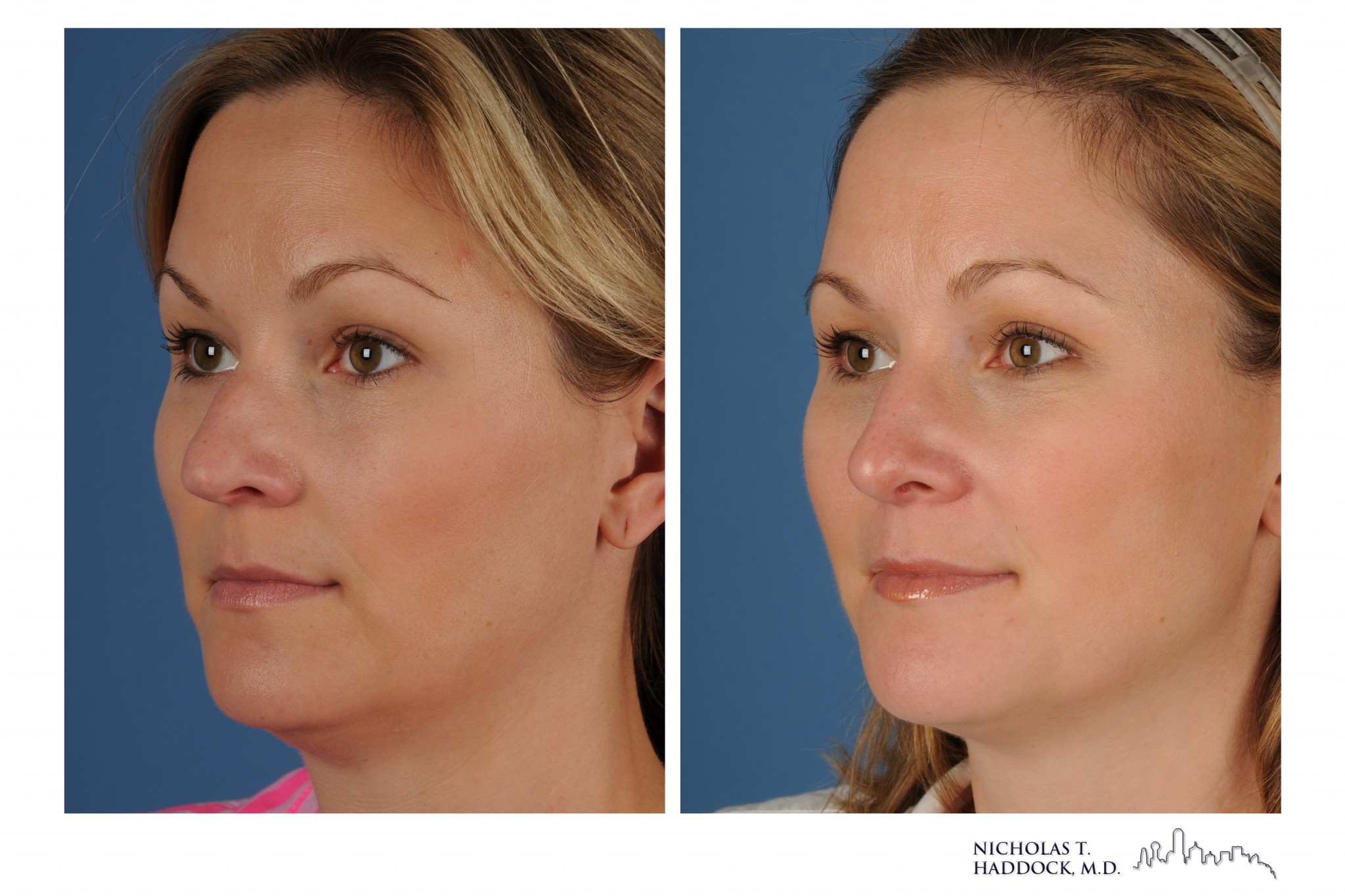 Rhinoplasty 1 LOBL