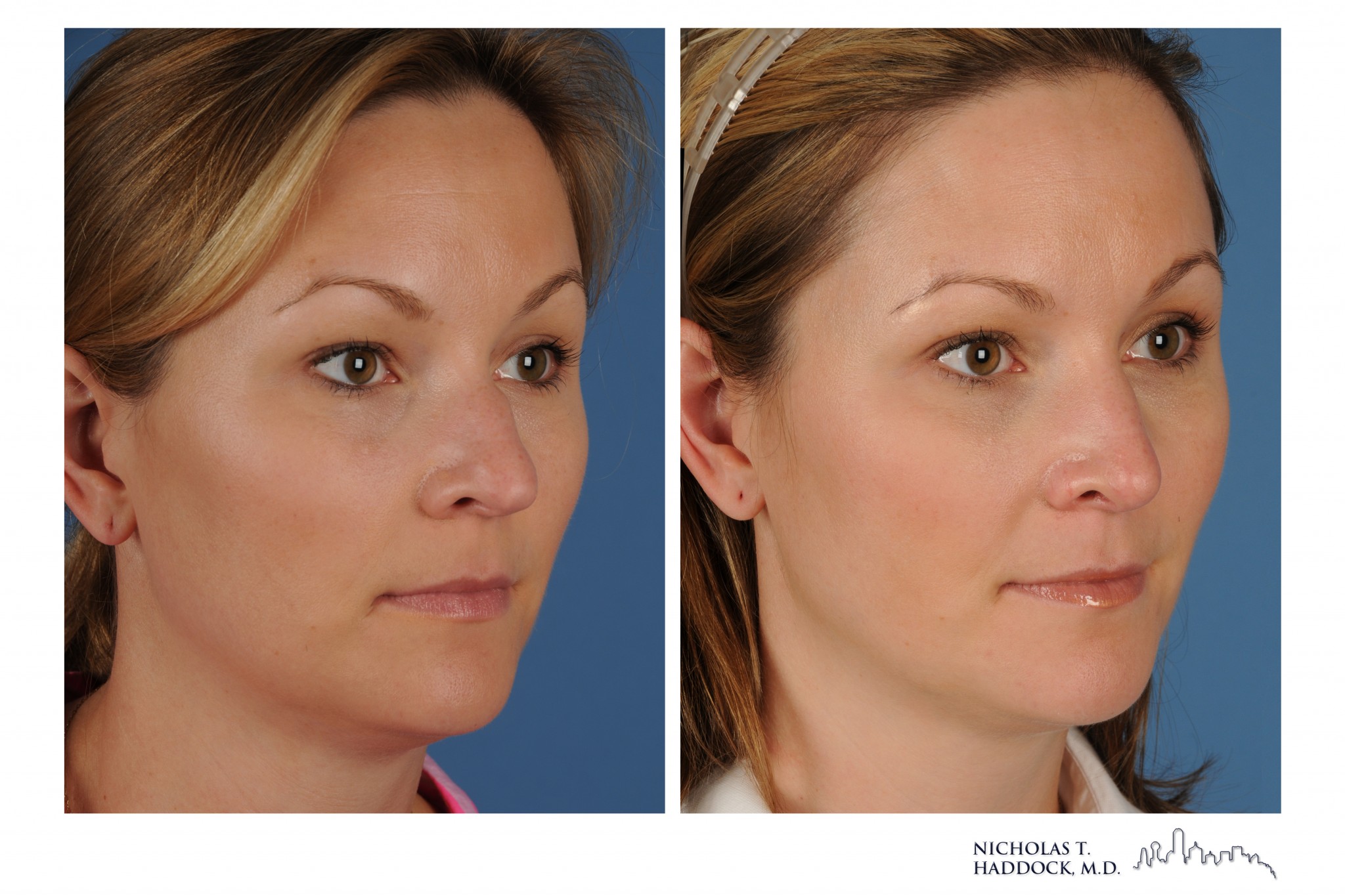 Rhinoplasty 1 ROBL