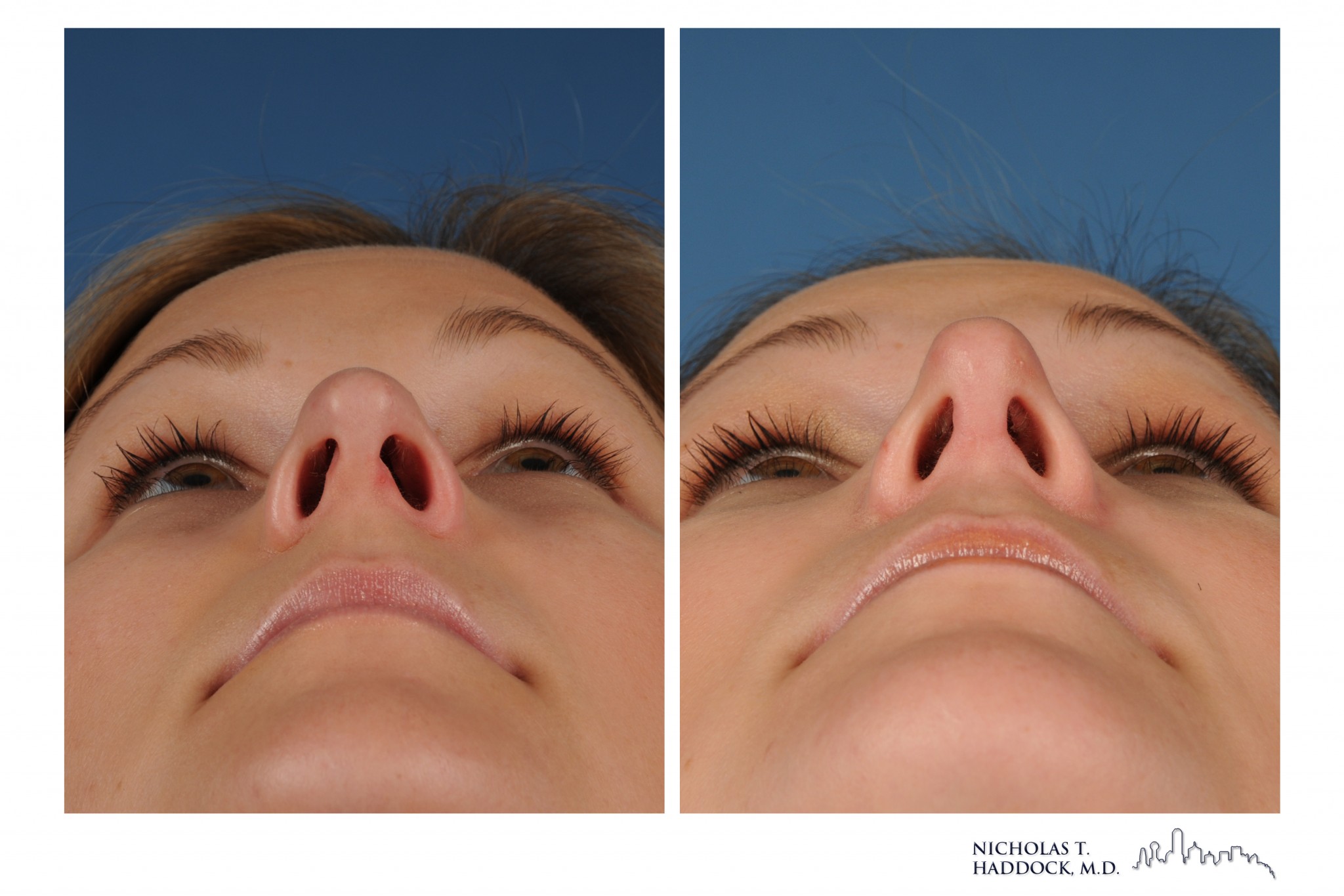 Rhinoplasty 1 Worm