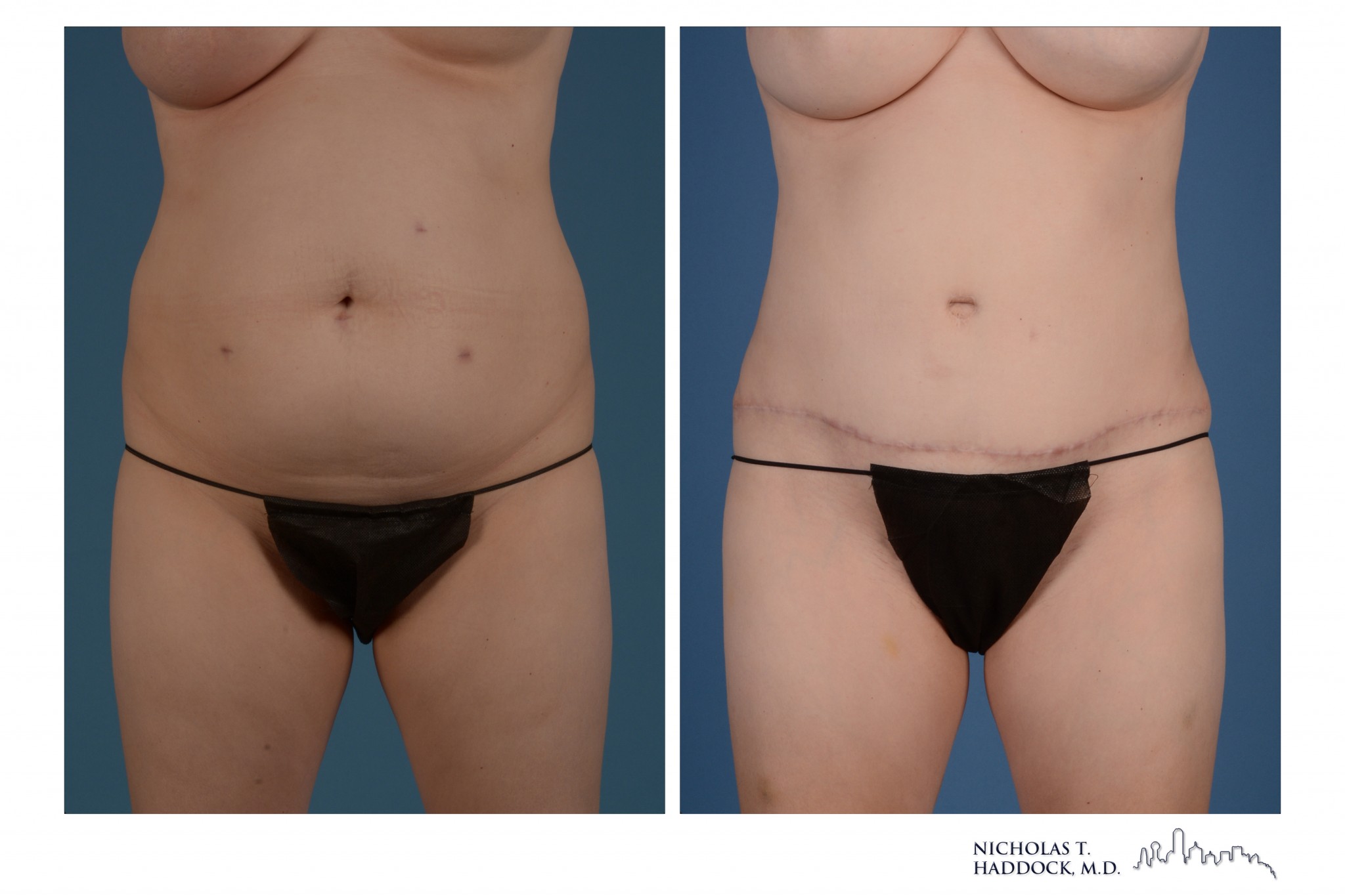 Abdominoplasty
