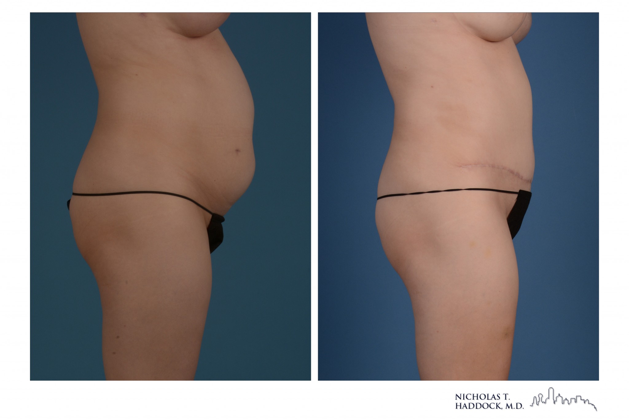 Abdominoplasty