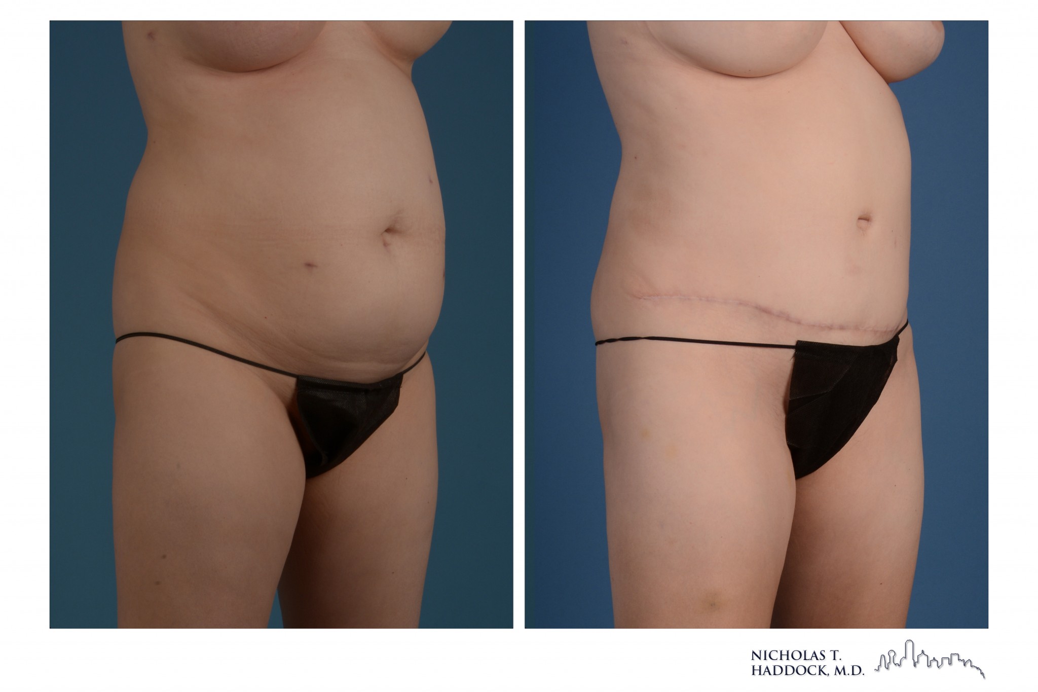 Abdominoplasty