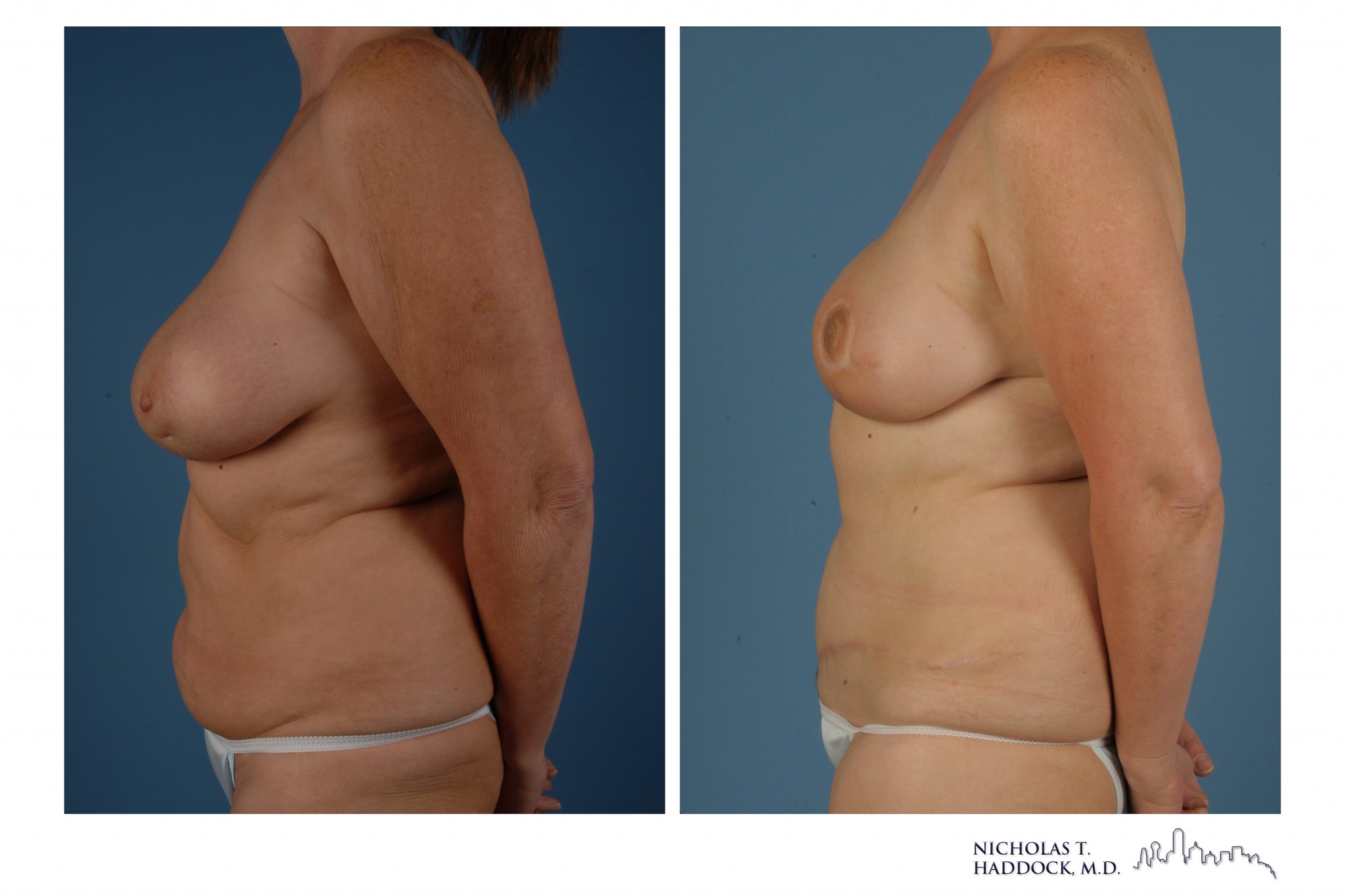 DIEP Flap