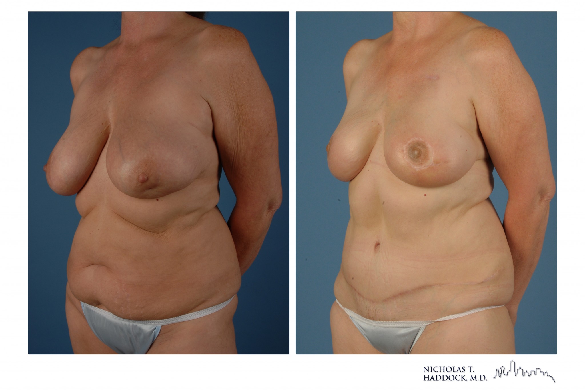 DIEP Flap