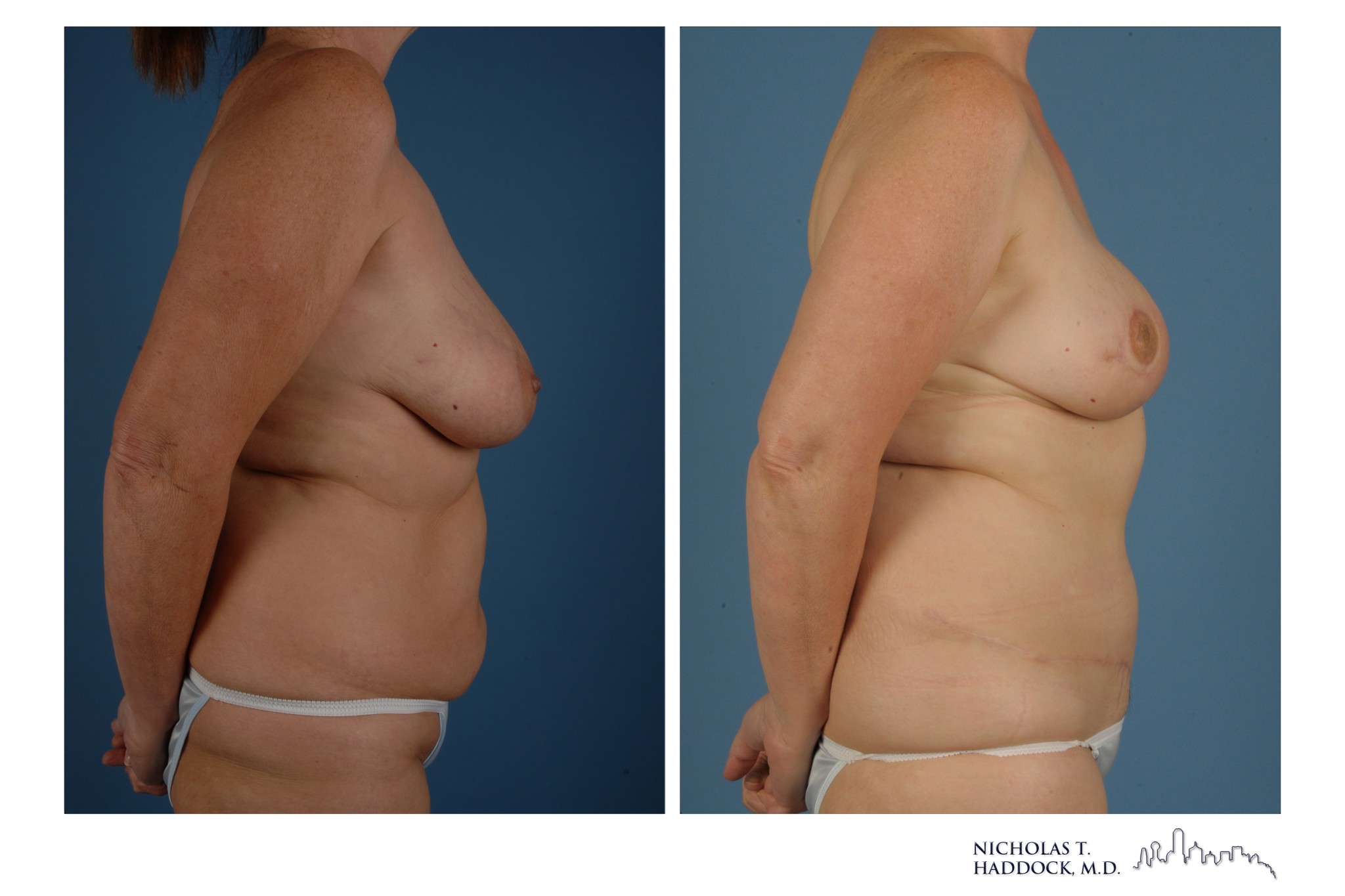 DIEP Flap