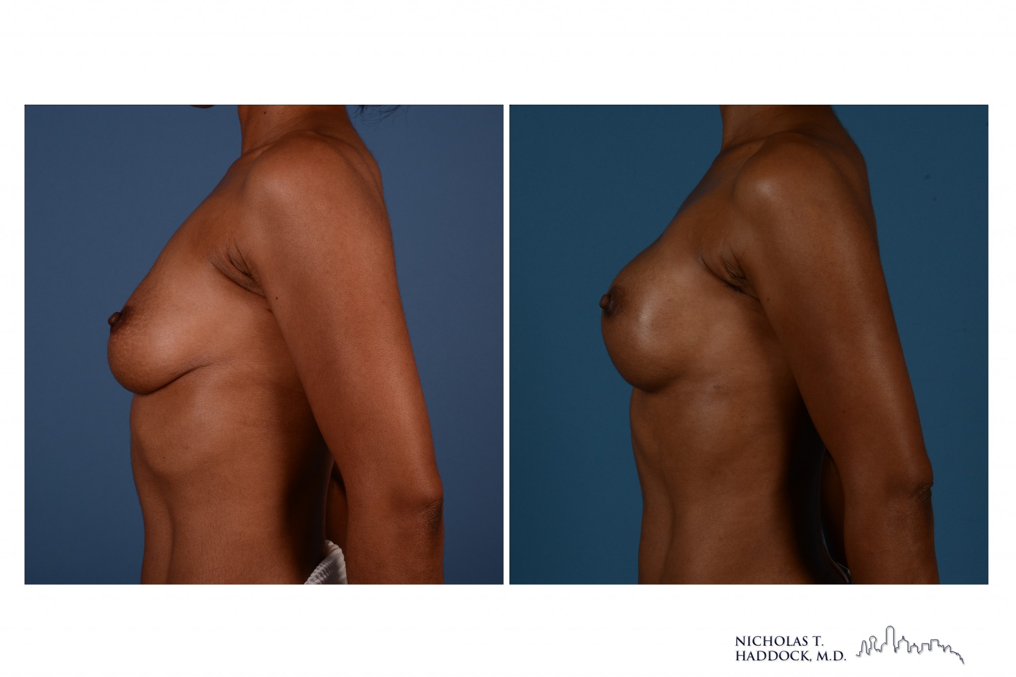 Breast Implant Reconstruction