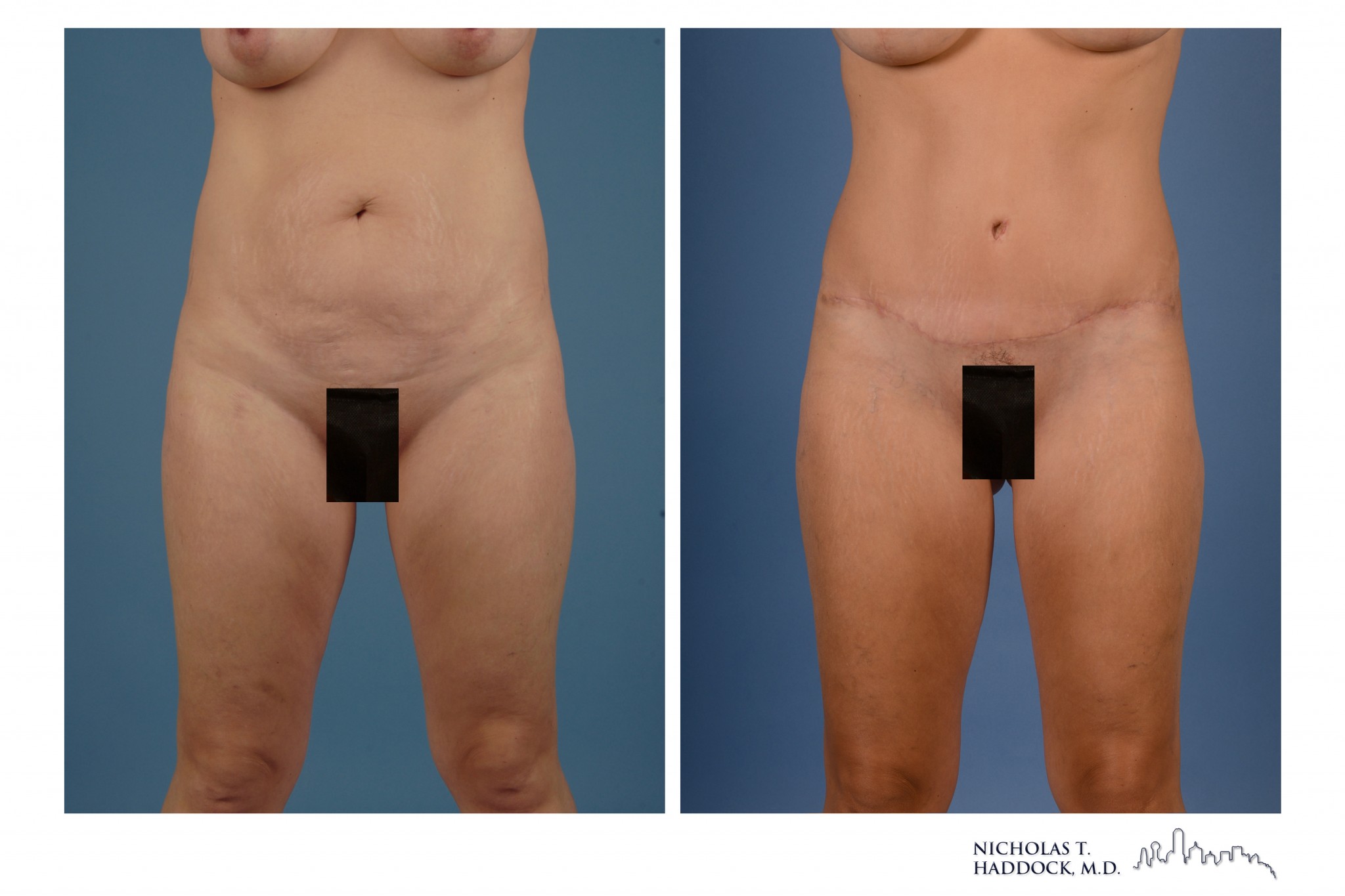 Abdominoplasty