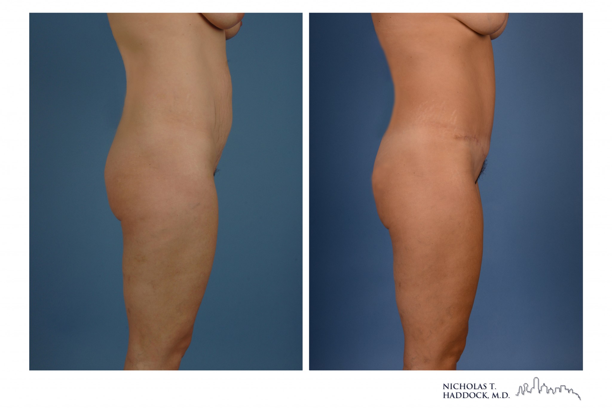 Abdominoplasty