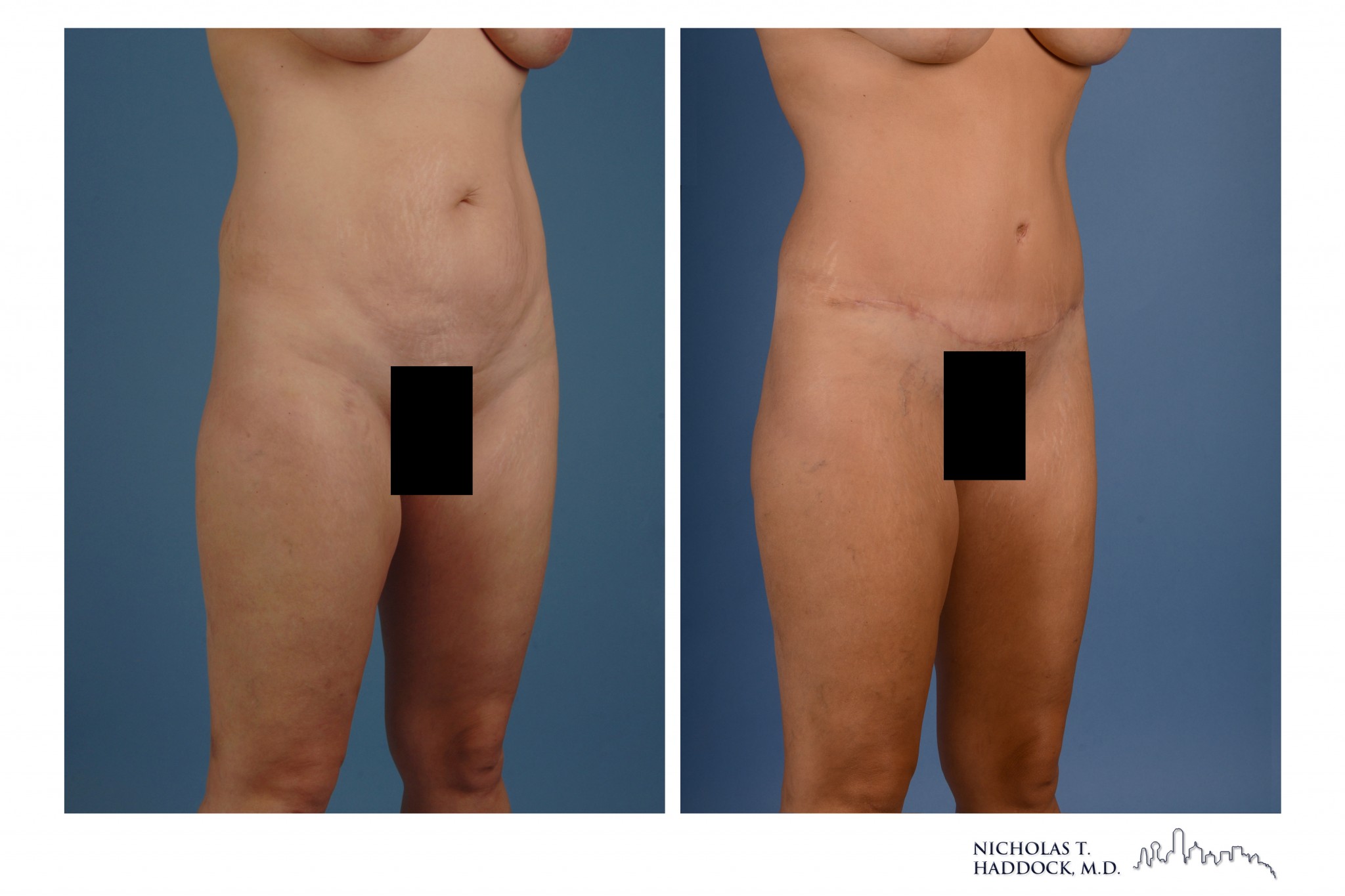 Abdominoplasty