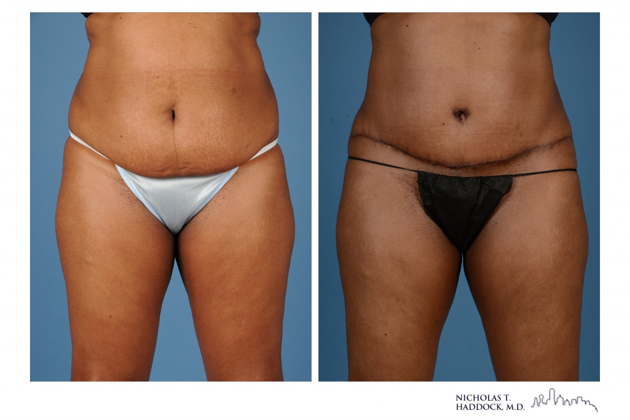 Abdominoplasty