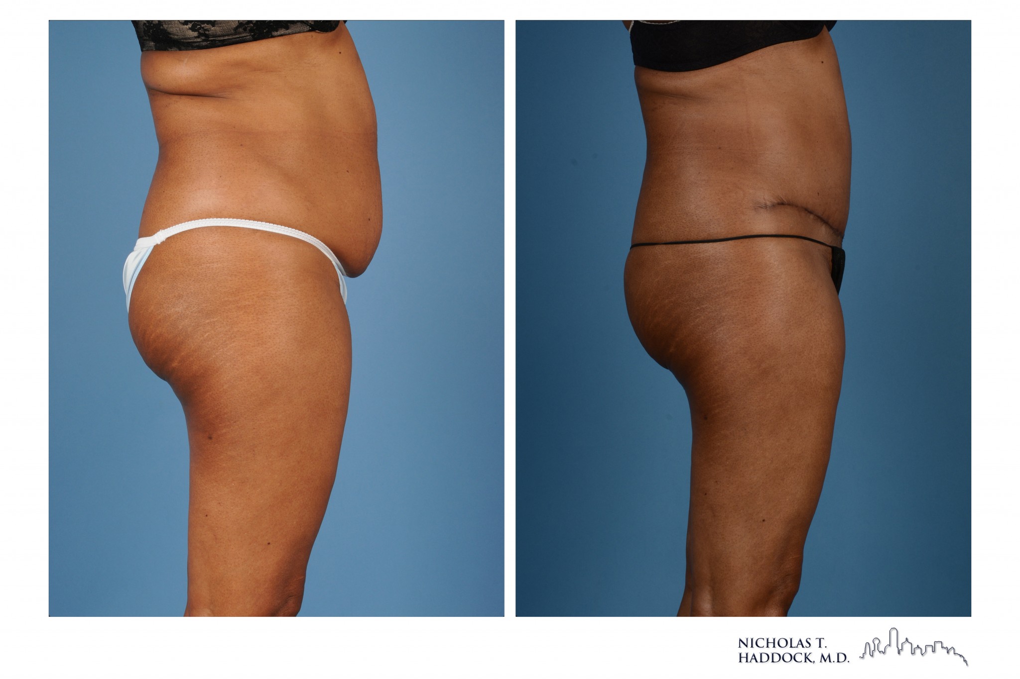 Abdominoplasty