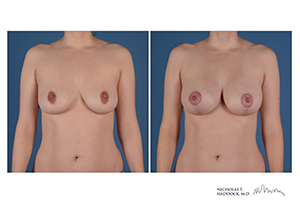 Breast Augmentation Mastopexy