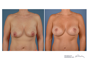 Breast Augmentation Mastopexy