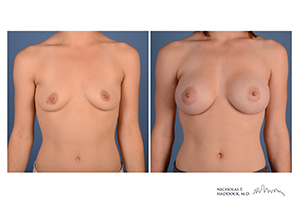 Breast Augmentation