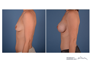 Breast Augmentation