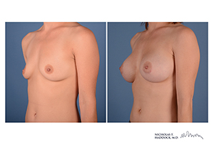 Breast Augmentation