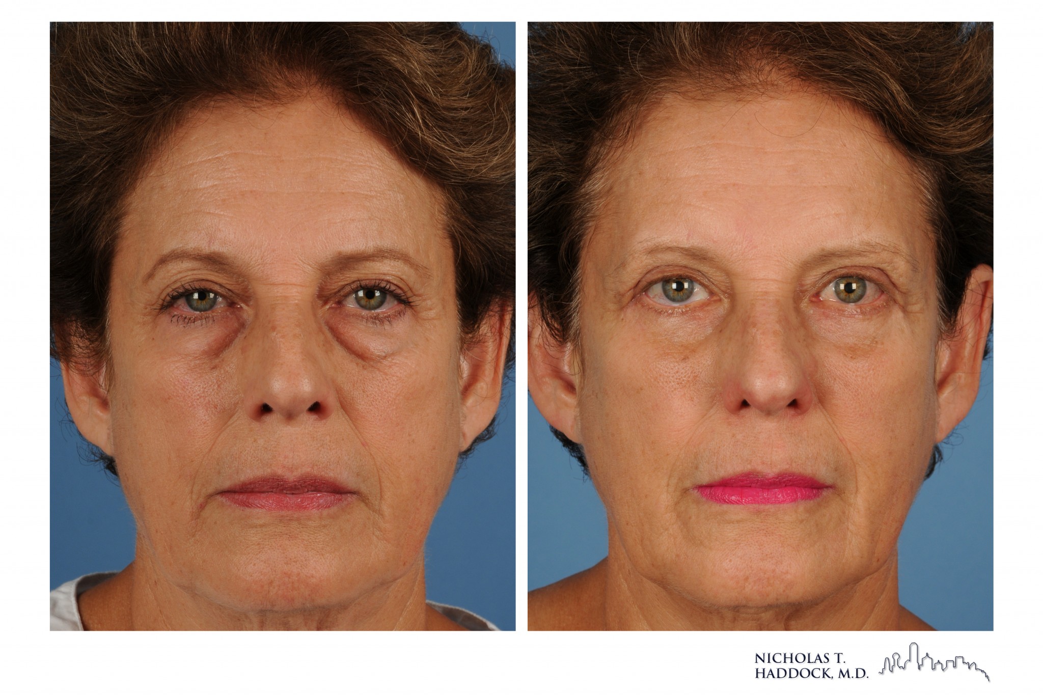 Blepharoplasty Dallas Fort Worth drnicholashaddock