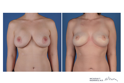 PAP flap