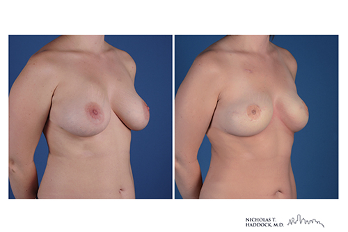 PAP flap
