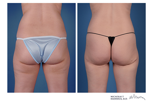 PAP flap