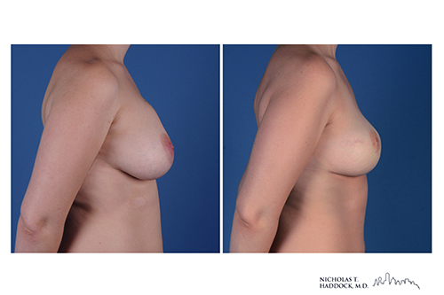 PAP flap