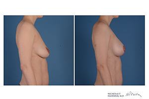 Breast Augmentation Mastopexy