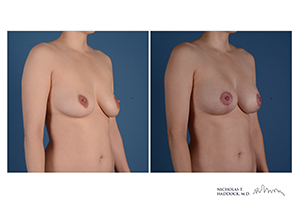 Breast Augmentation Mastopexy