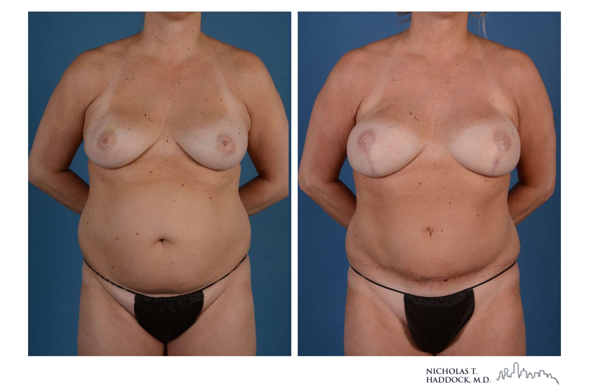 DIEP Flap