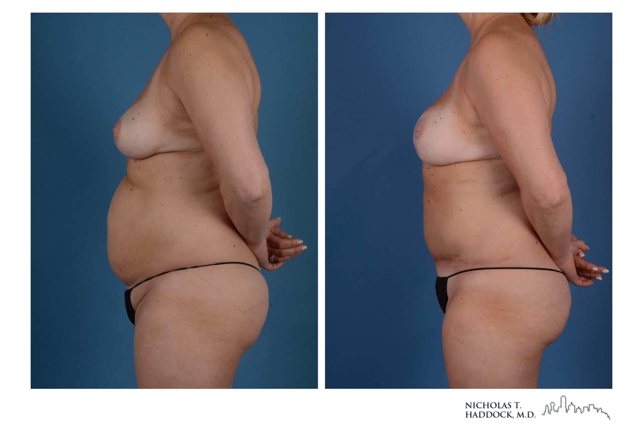 DIEP Flap