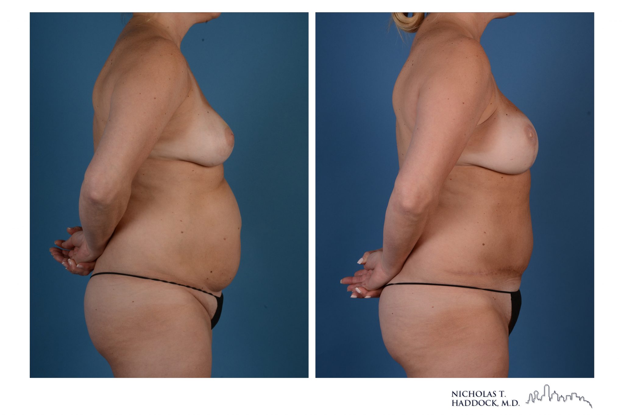DIEP Flap