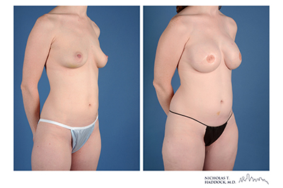 PAP Flap Before and After