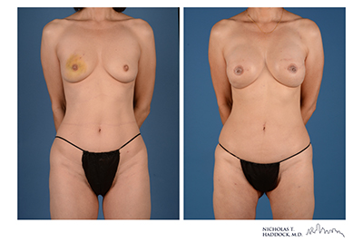 PAP Flap Before and After