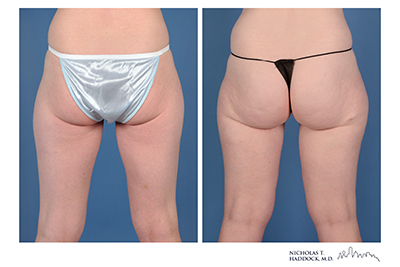 PAP Flap Before and After