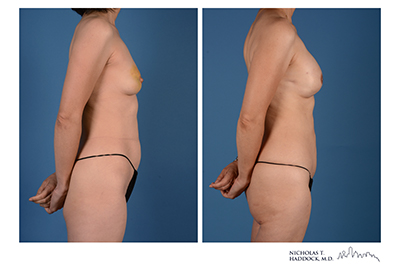 PAP Flap Before and After