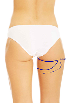 PAP Flap diagram
