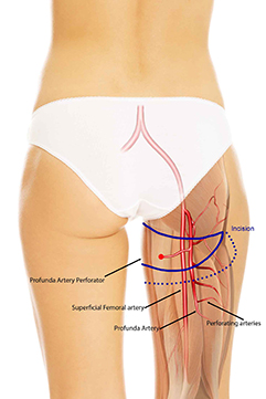 PAP Flap Diagram transparant