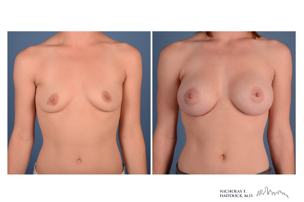 Breast Augmentation Breast Augmentation