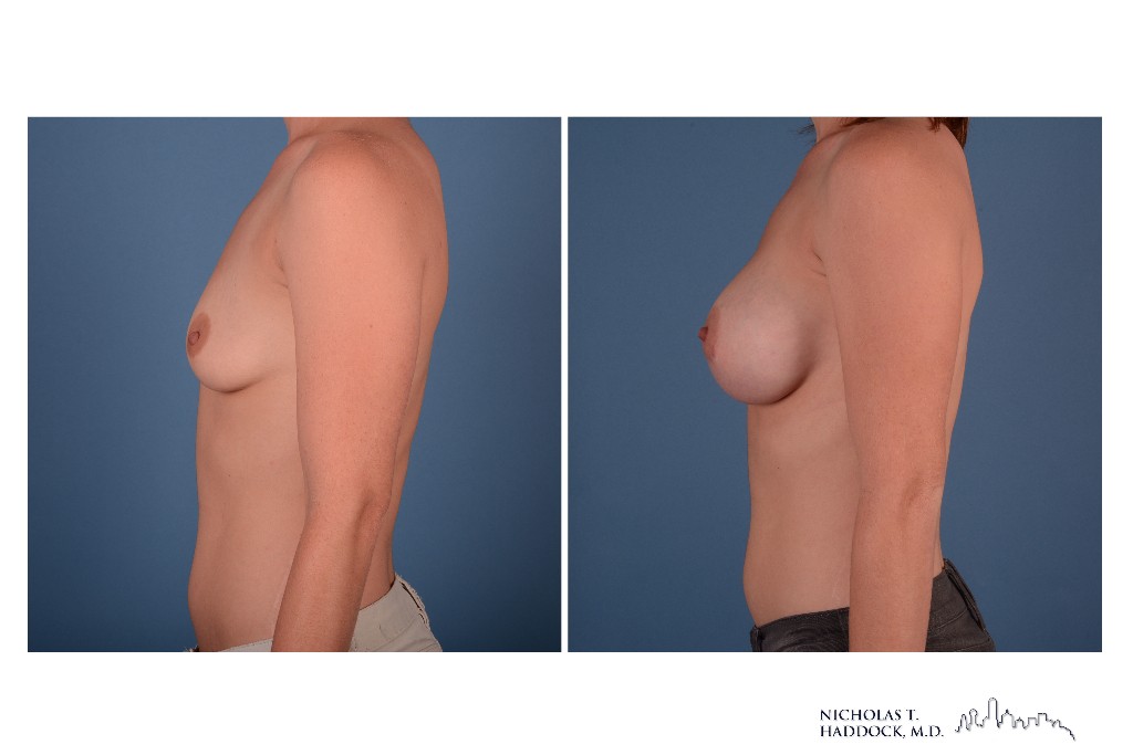 Breast Augmentation Breast Augmentation