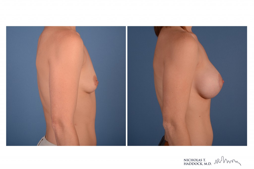 Breast Augmentation Breast Augmentation