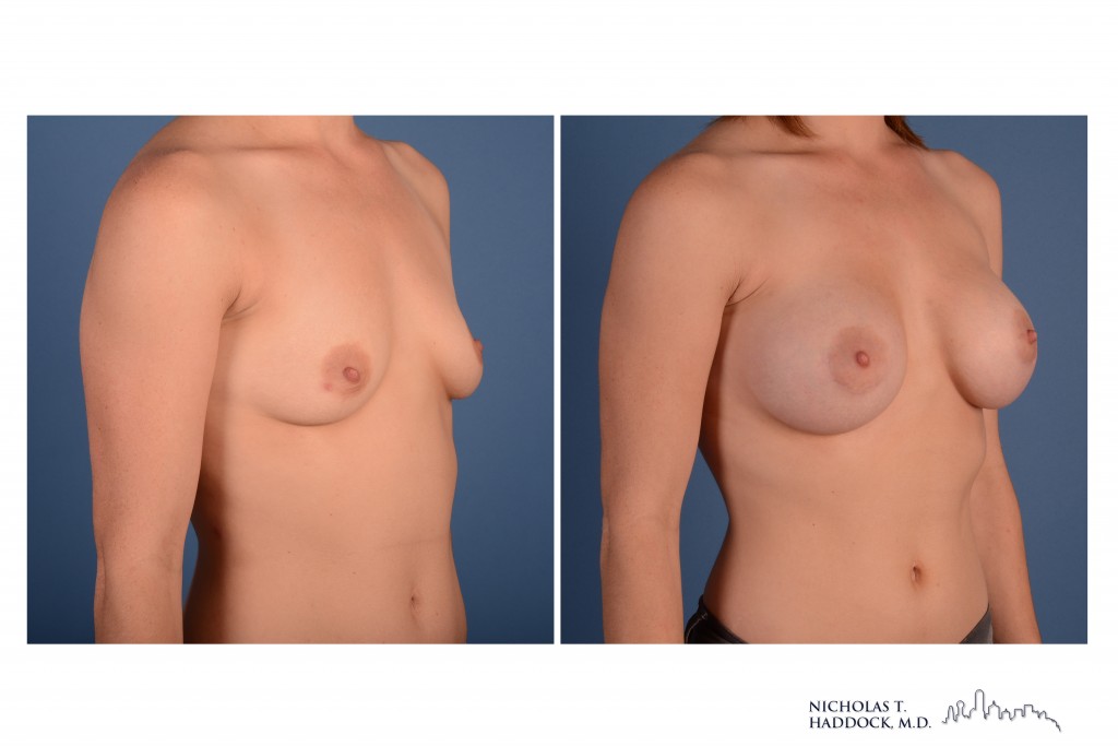 Breast Augmentation Breast Augmentation