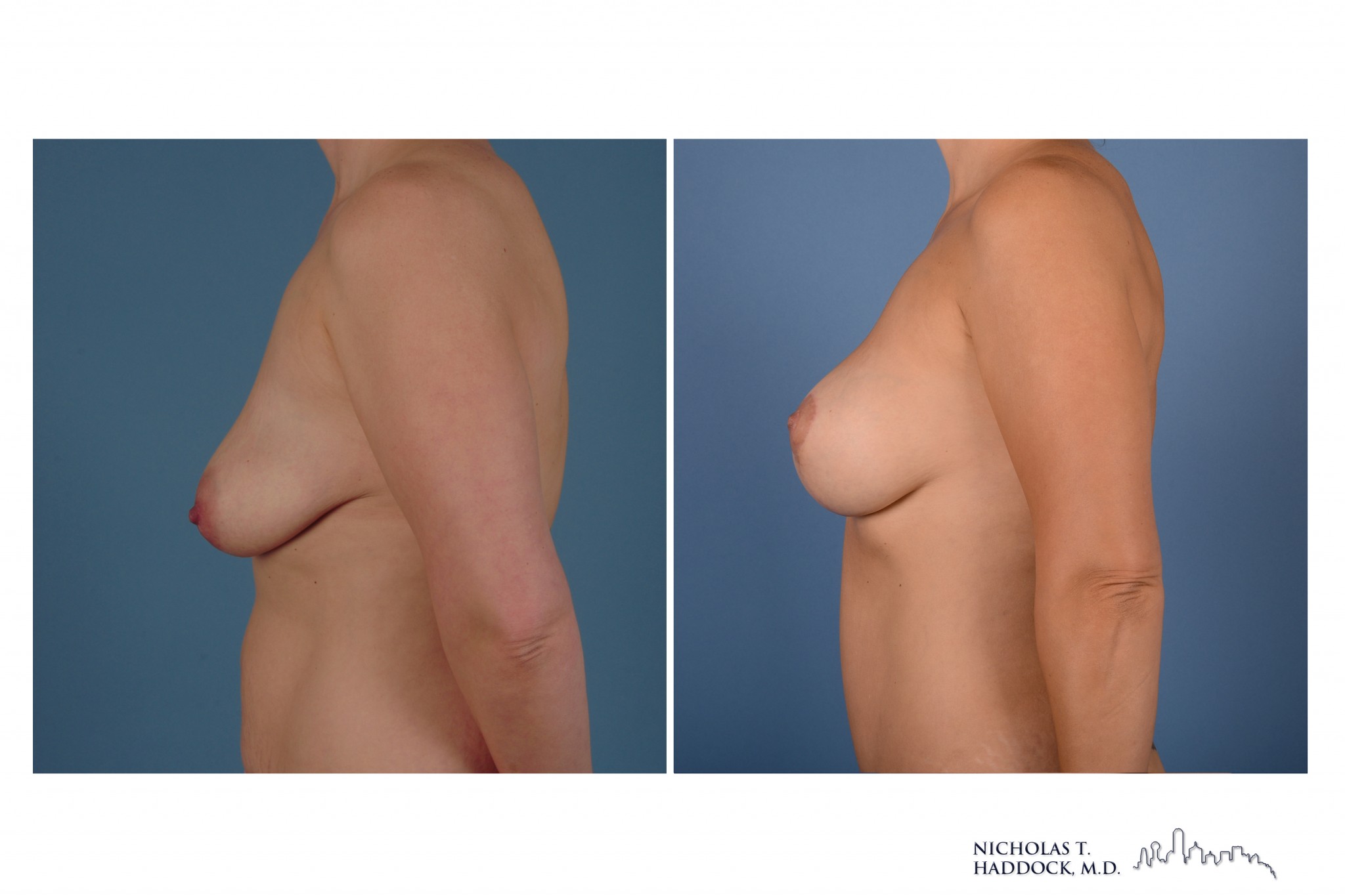 Breast Augmentation Mastopexy Breast Augmentation Mastopexy
