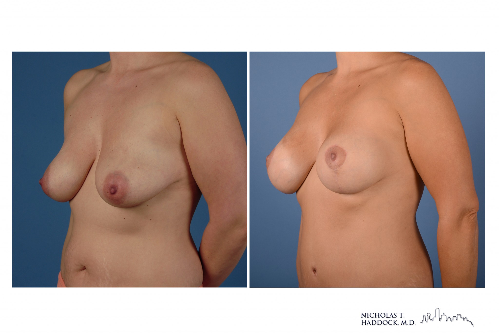 Breast Augmentation Mastopexy Breast Augmentation Mastopexy